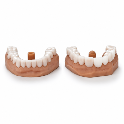 Snap On Smile, Snap on Veneers, Tak-Çıkar Dişler