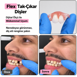 Flexible Partial Denture ROCHE Bridge