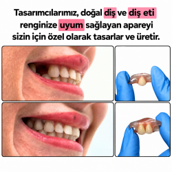 Flex Tak-Çıkar Dişler ROCHE KÖPRÜ