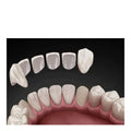 Veneer