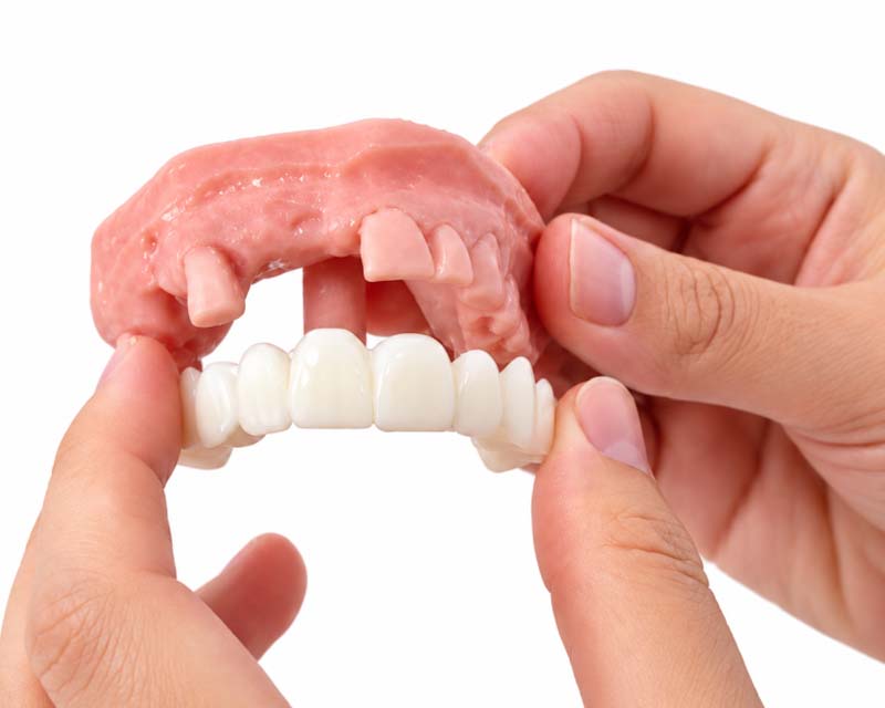 Snap-On Smile