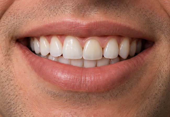 Roche Köprü sonrası ağız görünümü